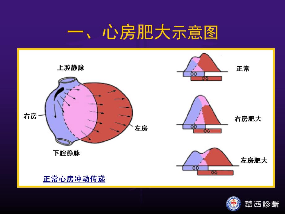 心电图-第三节 心房与心室肥大