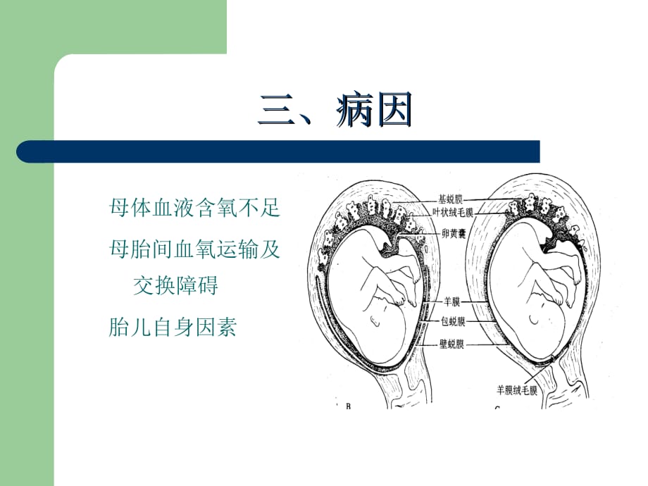 胎儿宫内窘迫医学课件