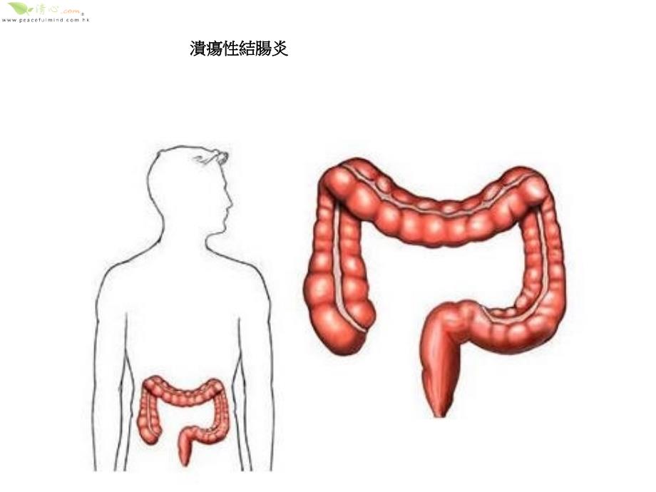 影响溃疡性结肠炎