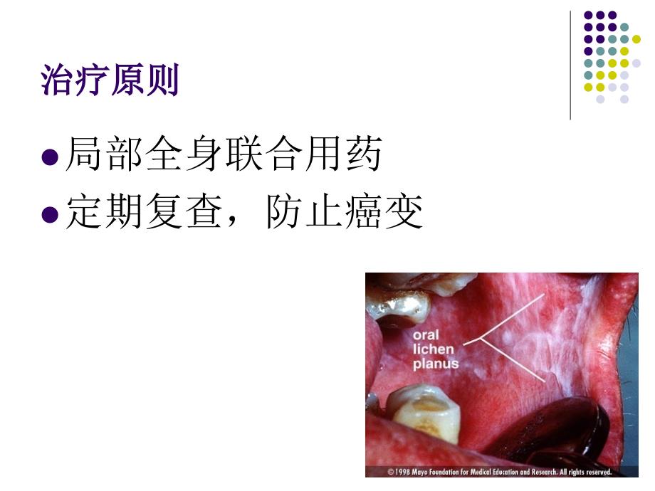 口腔扁平苔蘚治療與預後