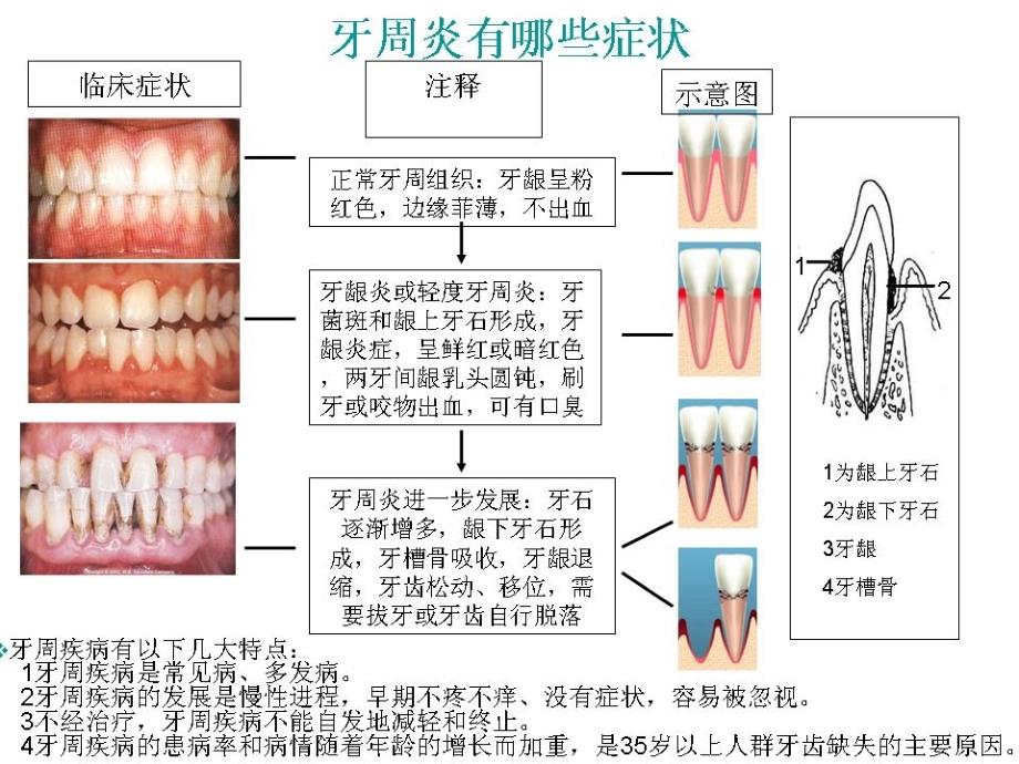 牙周炎的分类及临床表现ppt课件123