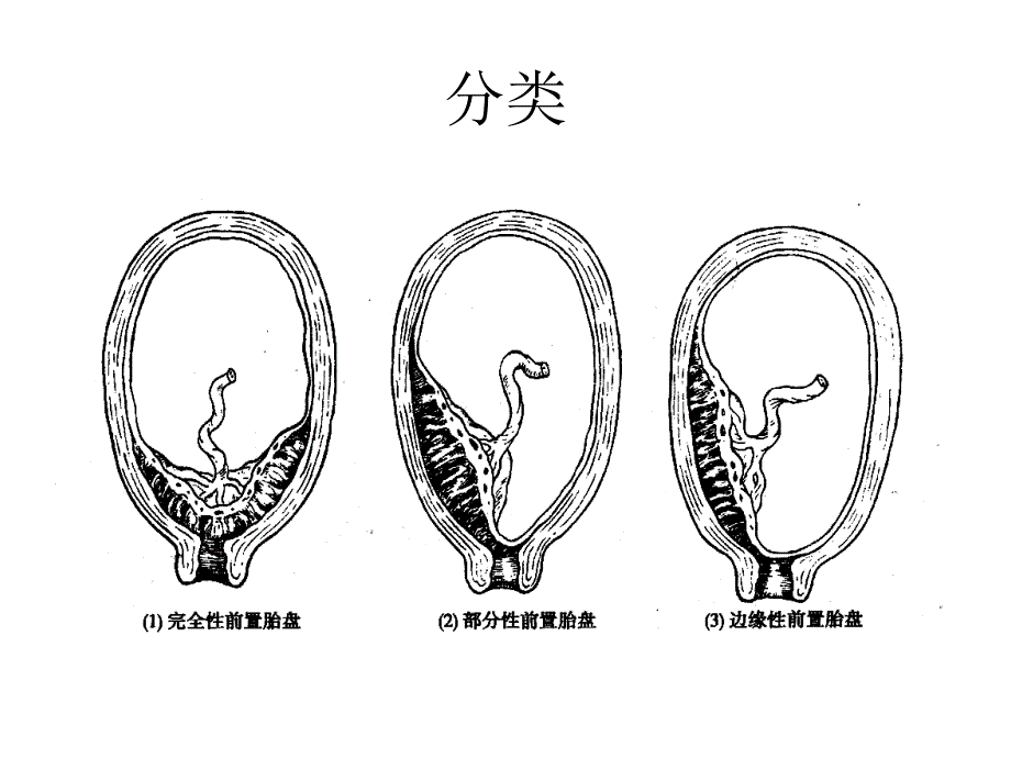 前置胎盘图解图片