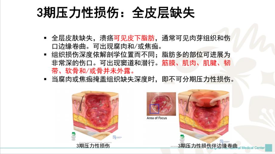 压力性损伤护理ppt课件