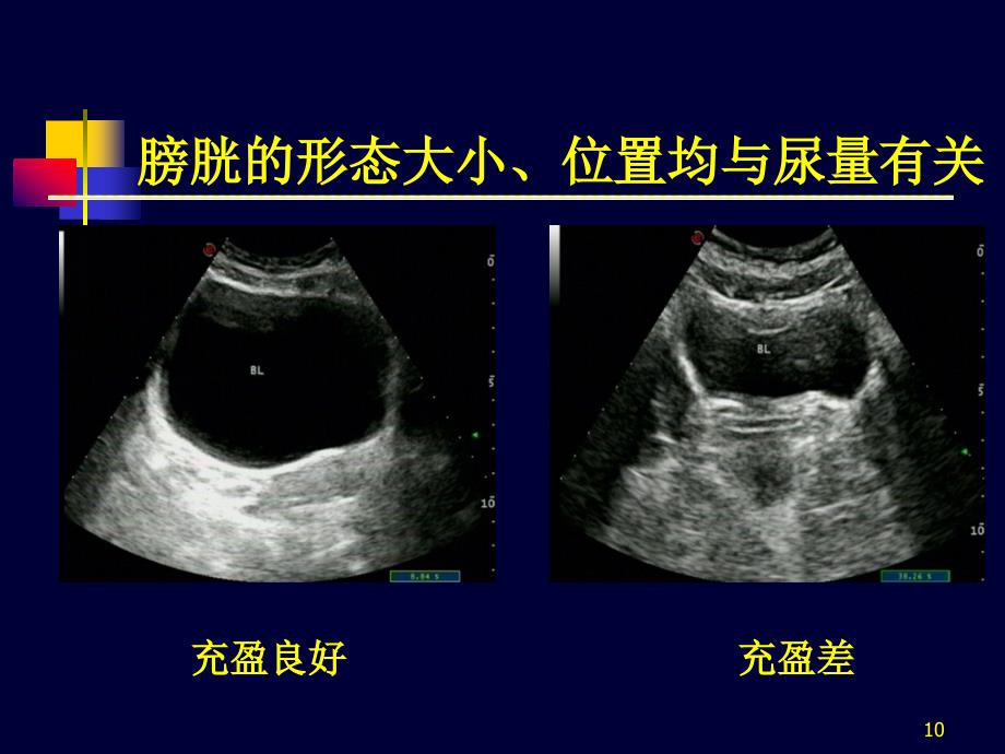 膀胱超声解剖图及解释图片