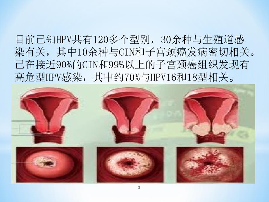 内生型宫颈癌图片图片
