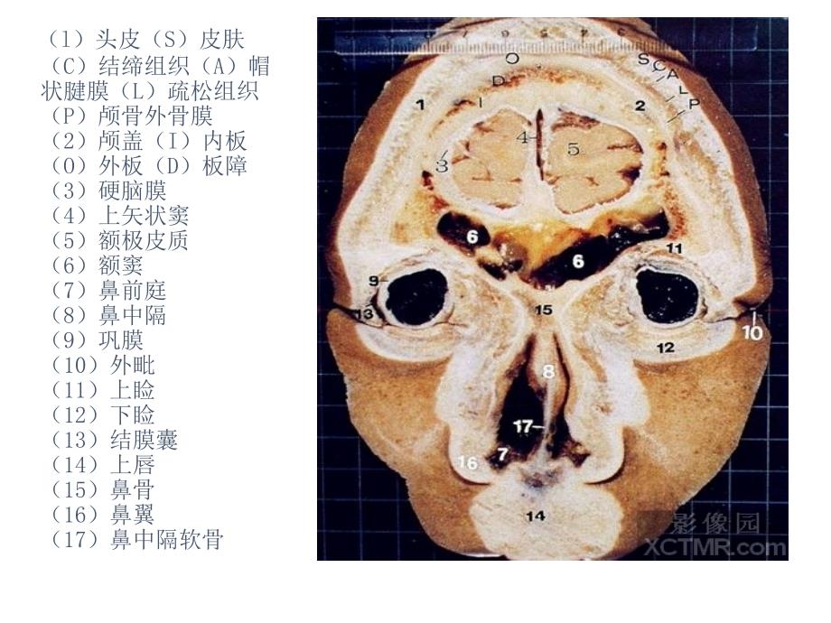 2020年人體斷層解剖圖譜大腦-頭(顱腦)冠狀位解剖示意圖 (1).