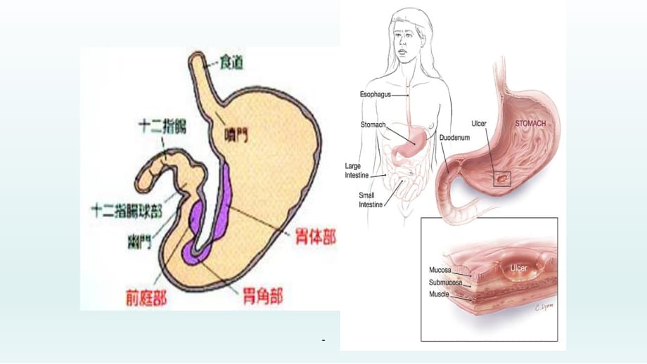 消化性潰瘍消化系統疾病內科學ppt課件