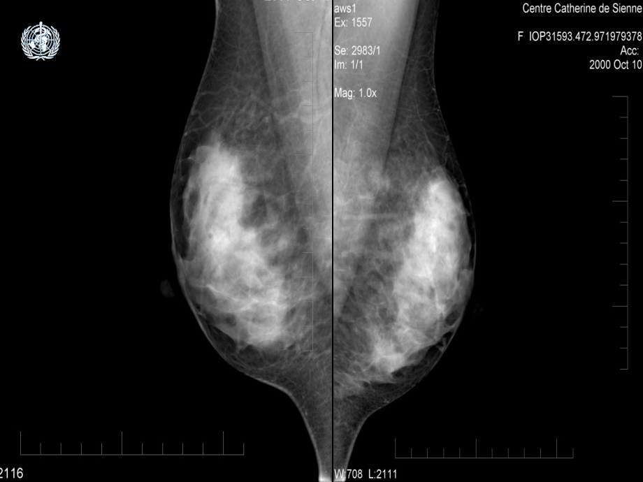 乳腺钼靶中央区位置图图片