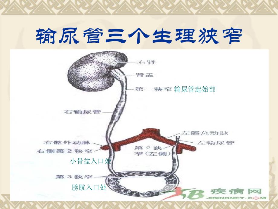 2015年輸尿管結石病人的護理業務學習ppt