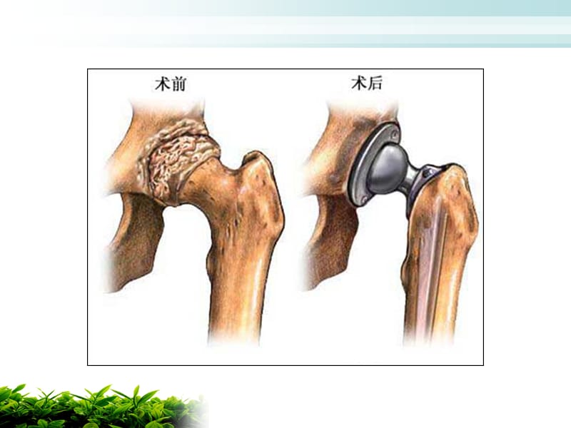 人工髋关节置换术后的护理课件