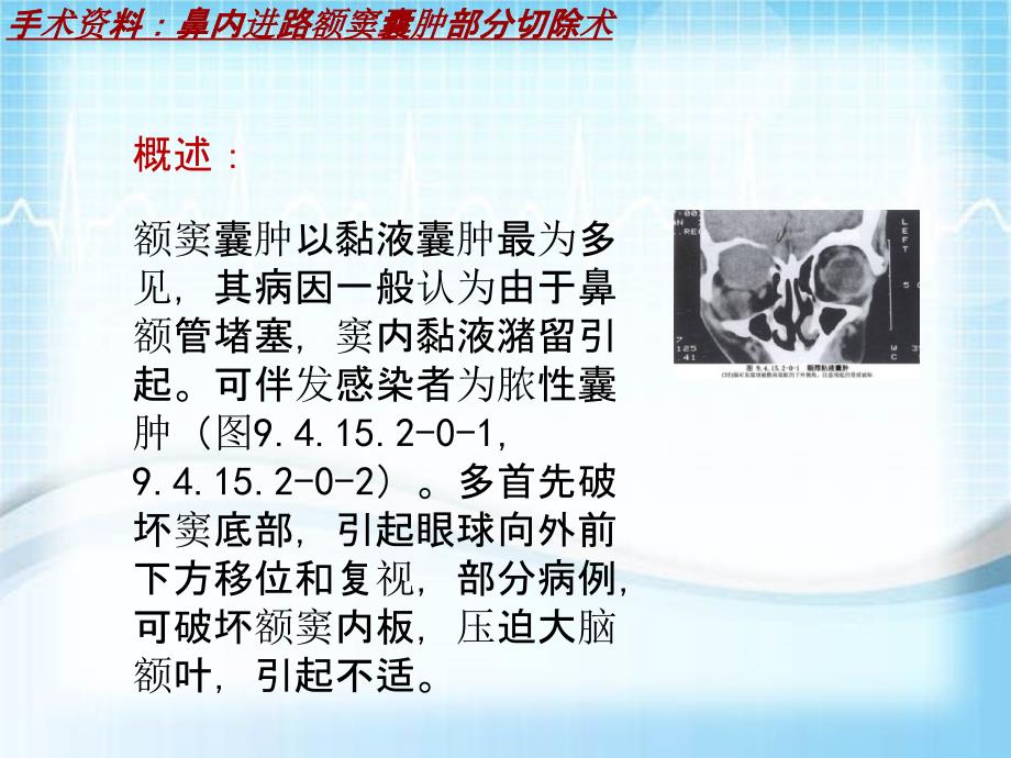 外科手術教學資料鼻內進路額竇囊腫部分切除術講解模板